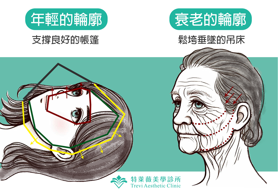 什麼是輪廓固定呢?