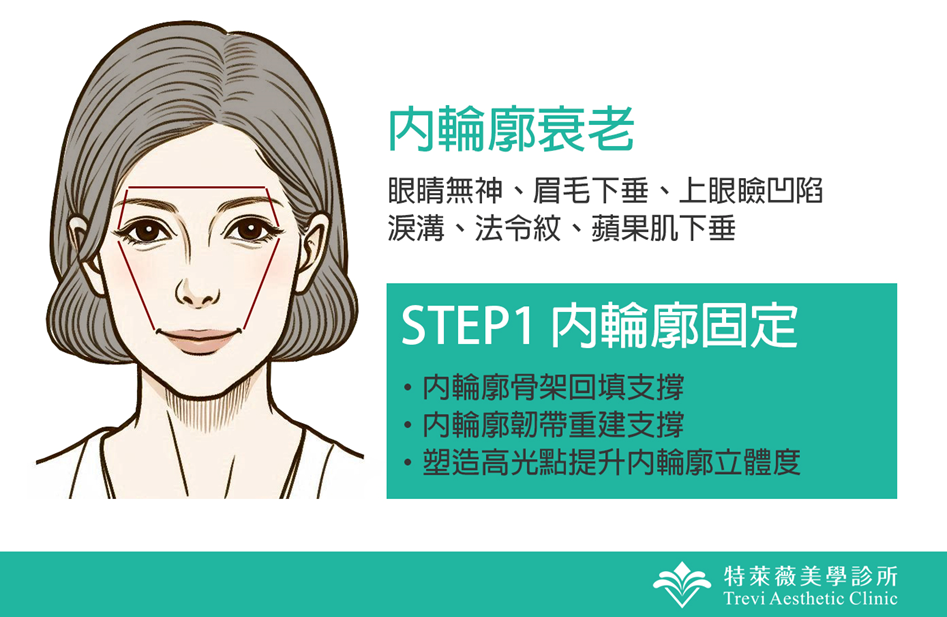 Step1 內輪廓固定